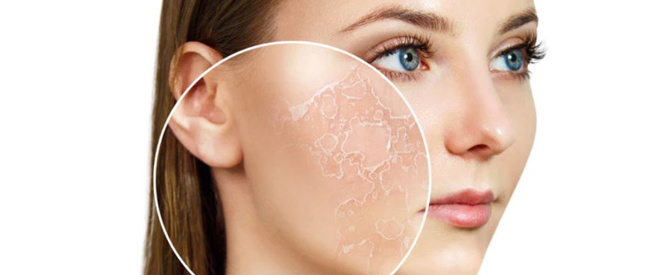 ویژگی‌های پوست خشک