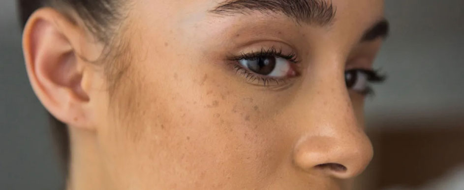 علل لک صورت